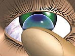 aplicarea unei lentile de contact