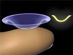 lentila de contact asezata incorect